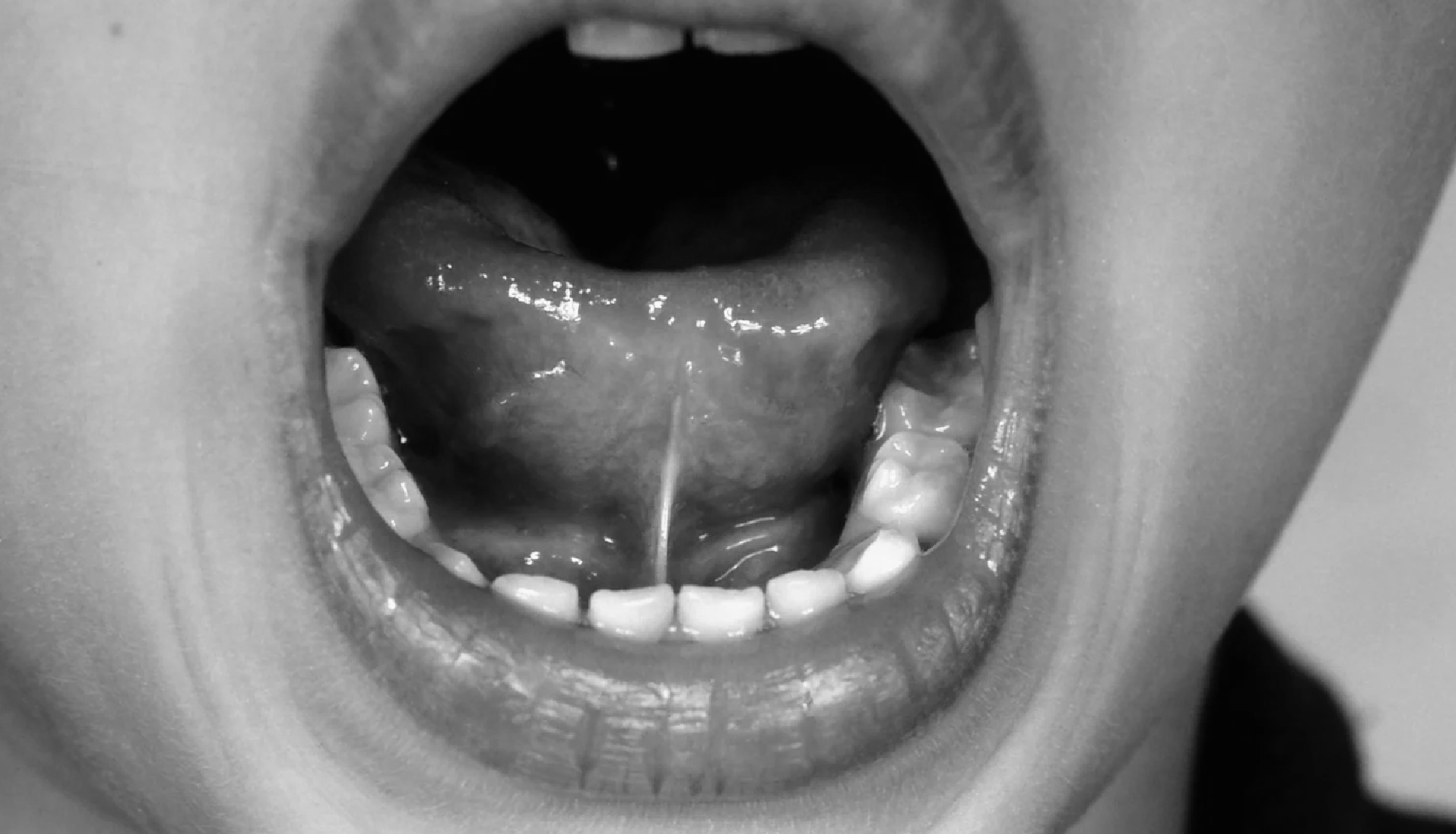 <p>Evaluación integral de la Anquiloglosia en Odontología Anatomía de frenillo lingual</p>